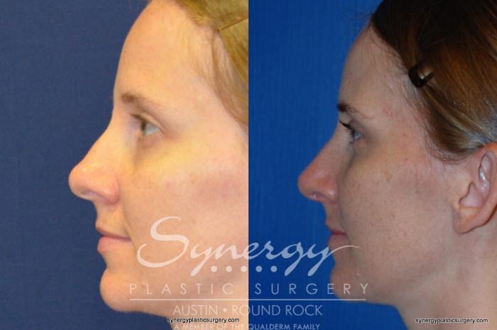 Before & After Rhinoplasty Case 244 View #5 View in Austin, TX