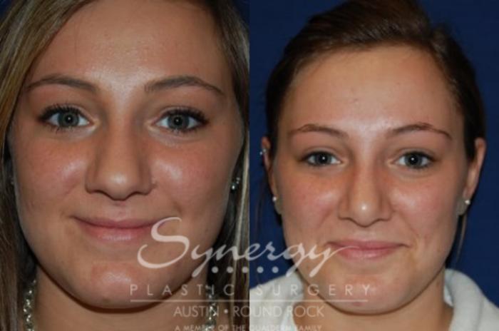 Before & After Rhinoplasty Case 44 View #2 View in Austin, TX