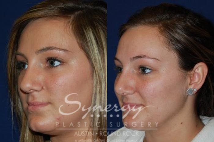 Before & After Rhinoplasty Case 44 View #3 View in Austin, TX