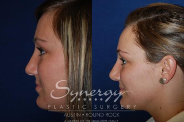 Before & After Rhinoplasty Case 44 View #4 View in Austin, TX