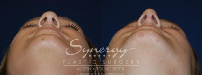 Before & After Rhinoplasty Case 44 View #5 View in Austin, TX