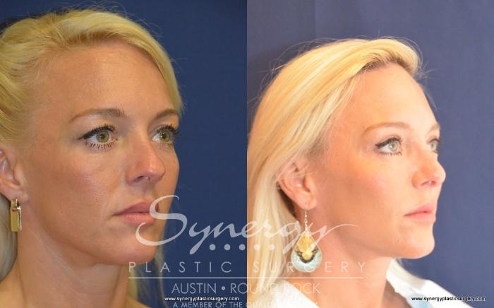 Before & After Rhinoplasty Case 488 View #2 View in Austin, TX