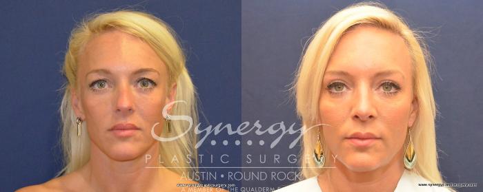 Before & After Rhinoplasty Case 488 View #3 View in Austin, TX