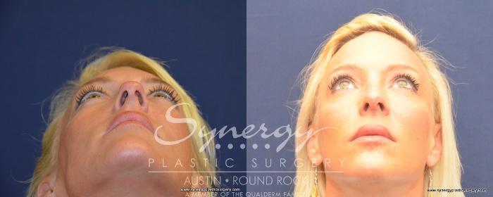 Before & After Rhinoplasty Case 488 View #4 View in Austin, TX