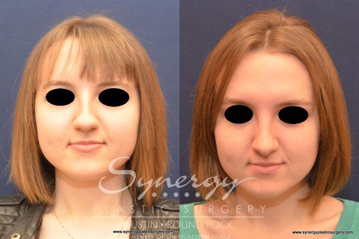 Before & After Rhinoplasty Case 556 View #1 View in Austin, TX