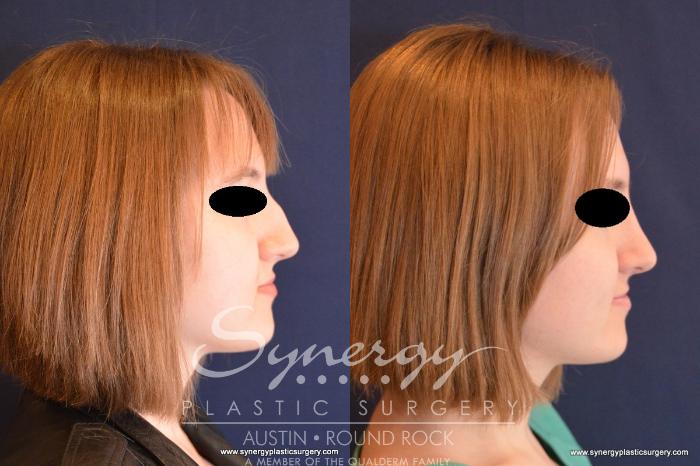 Before & After Rhinoplasty Case 556 View #2 View in Austin, TX