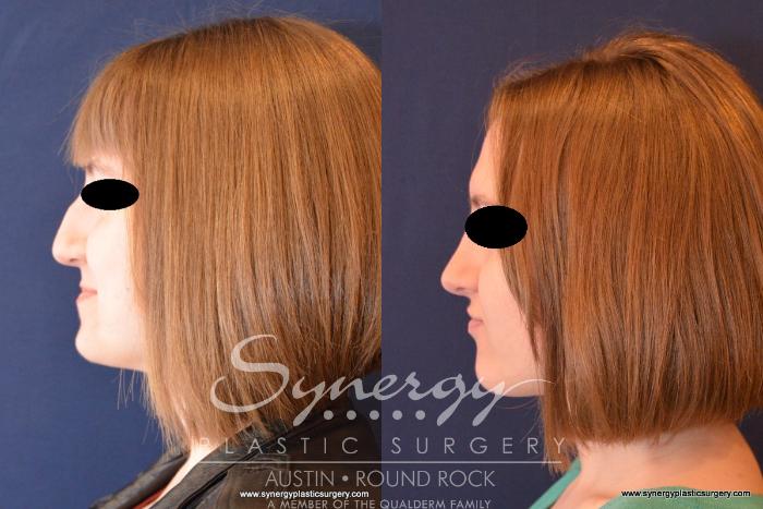 Before & After Rhinoplasty Case 556 View #3 View in Austin, TX