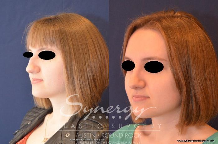 Before & After Rhinoplasty Case 556 View #4 View in Austin, TX