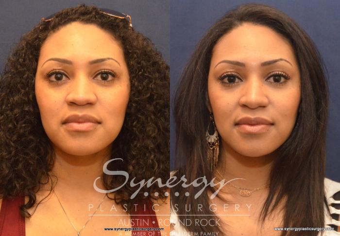 Before & After Rhinoplasty Case 603 View #1 View in Austin, TX