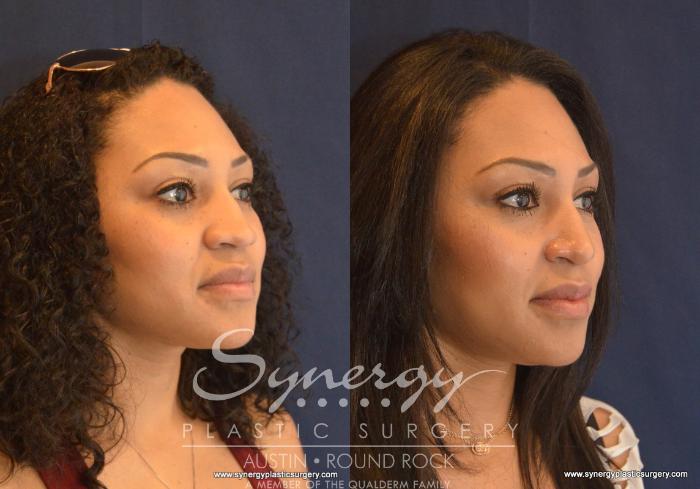 Before & After Rhinoplasty Case 603 View #2 View in Austin, TX