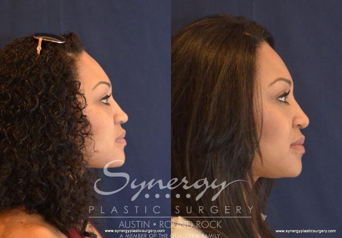 Before & After Rhinoplasty Case 603 View #3 View in Austin, TX