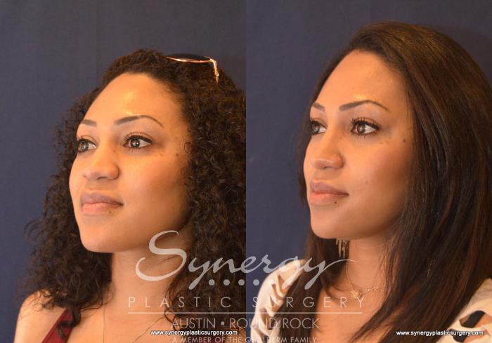 Before & After Rhinoplasty Case 603 View #4 View in Austin, TX