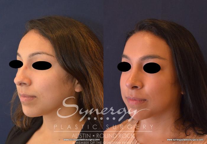 Before & After Rhinoplasty Case 624 View #1 View in Austin, TX