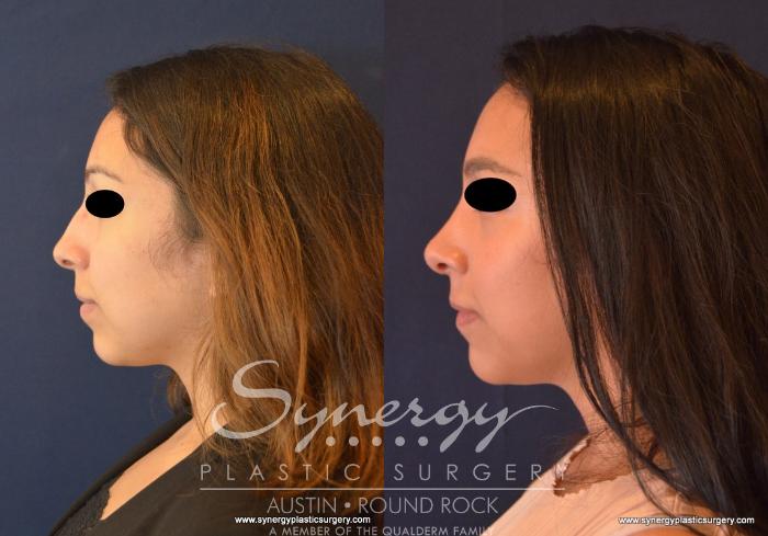 Before & After Rhinoplasty Case 624 View #2 View in Austin, TX