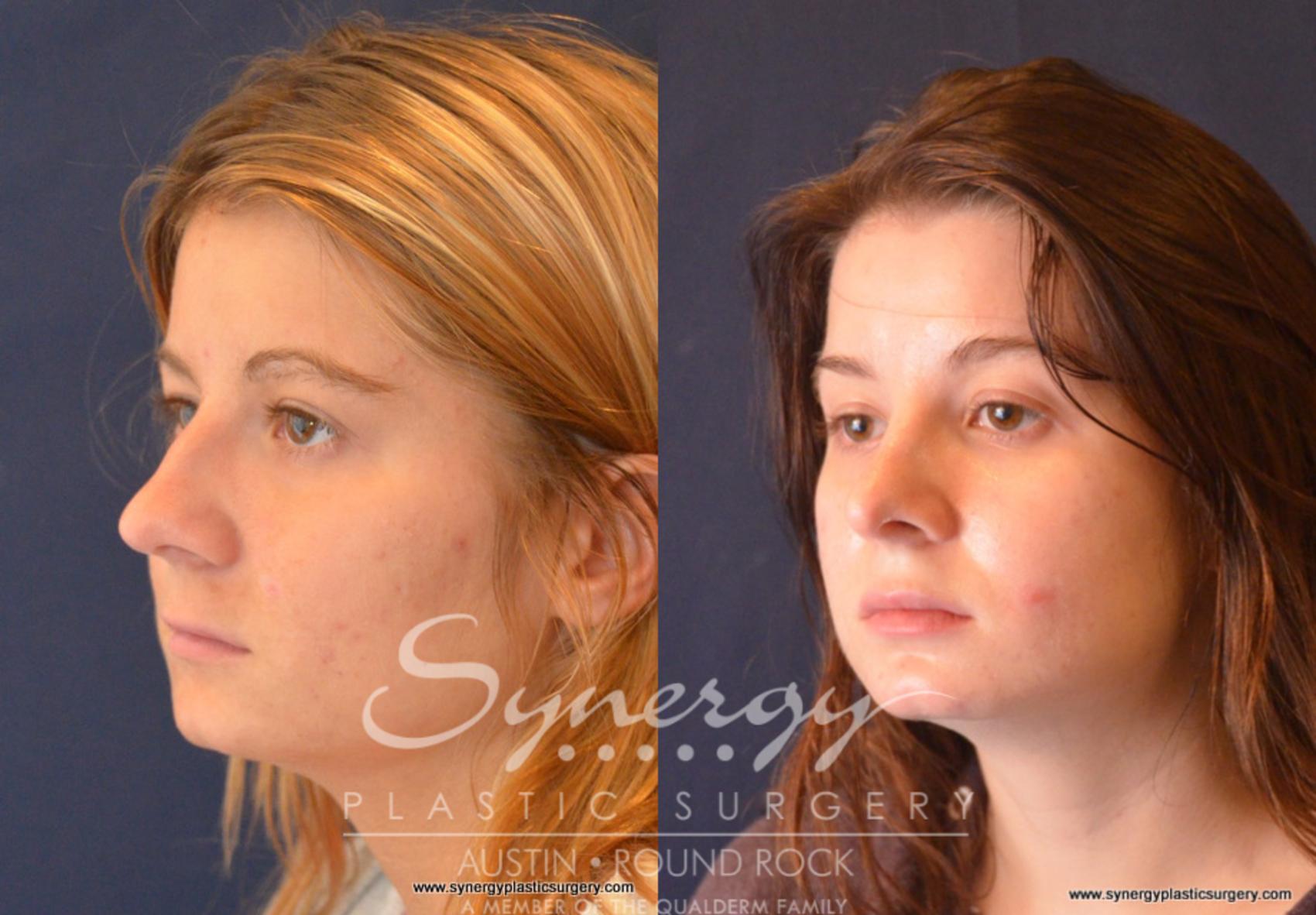 Before & After Rhinoplasty Case 647 View #1 View in Austin, TX