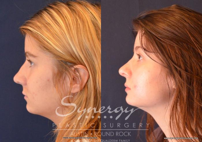 Before & After Rhinoplasty Case 647 View #2 View in Austin, TX