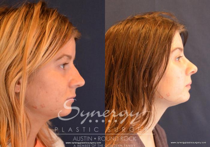 Before & After Rhinoplasty Case 647 View #3 View in Austin, TX