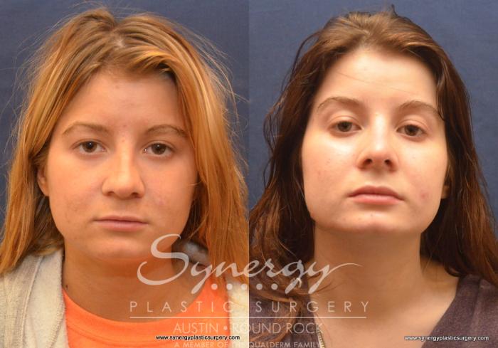 Before & After Rhinoplasty Case 647 View #4 View in Austin, TX