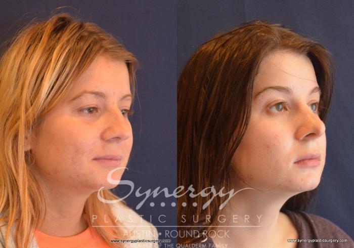 Before & After Rhinoplasty Case 647 View #5 View in Austin, TX