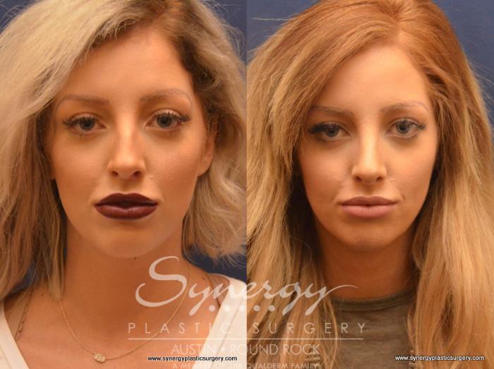 Before & After Rhinoplasty Case 656 View #1 View in Austin, TX