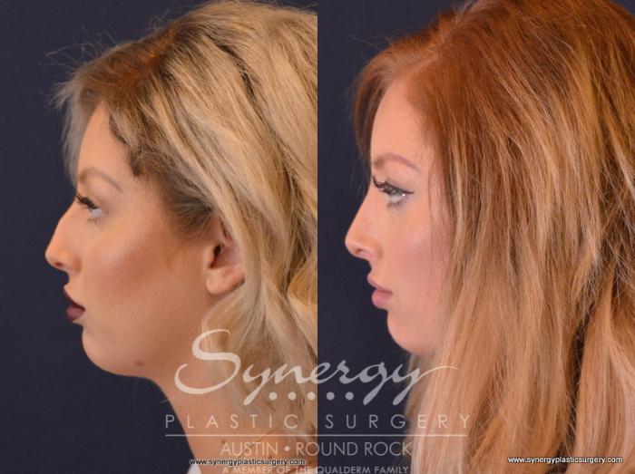 Before & After Rhinoplasty Case 656 View #2 View in Austin, TX