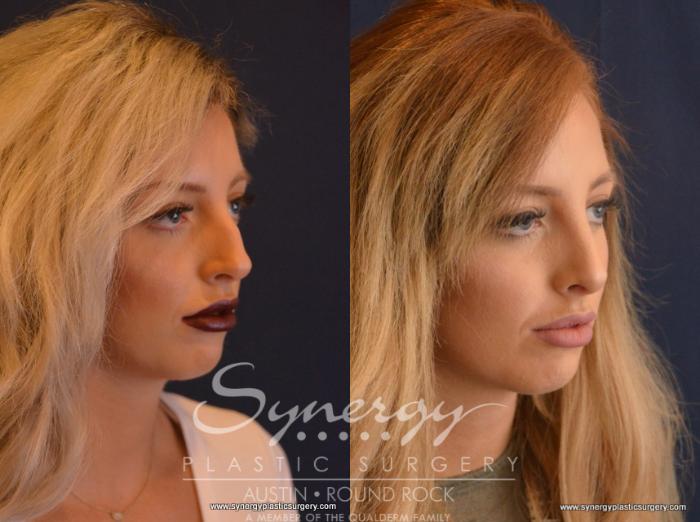 Before & After Rhinoplasty Case 656 View #3 View in Austin, TX