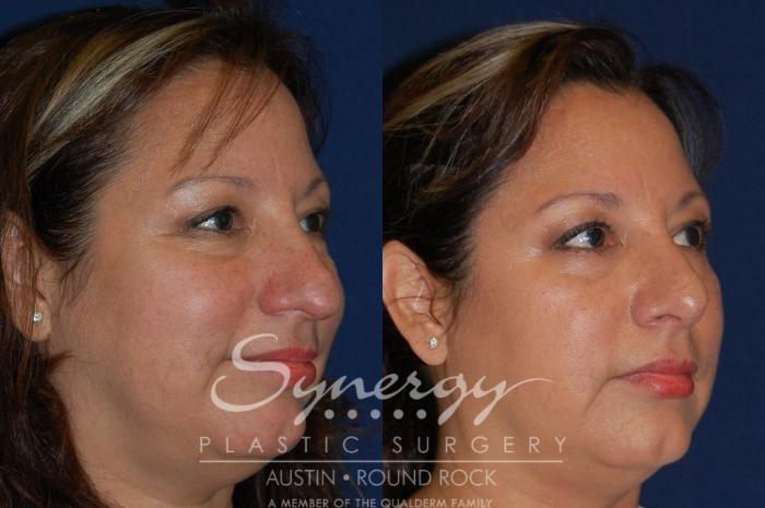 Before & After Rhinoplasty Case 89 View #2 View in Austin, TX