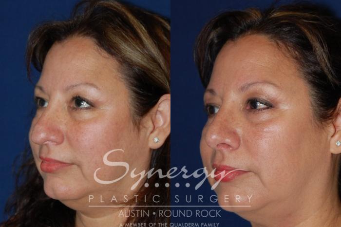 Before & After Rhinoplasty Case 89 View #3 View in Austin, TX