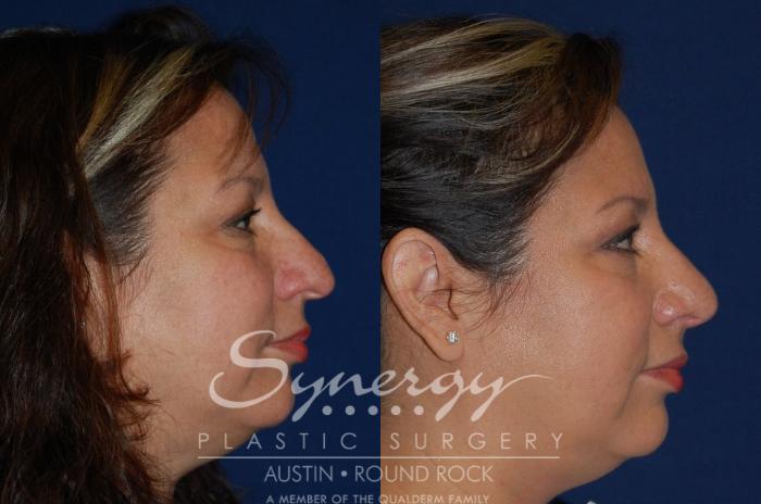 Before & After Rhinoplasty Case 89 View #4 View in Austin, TX
