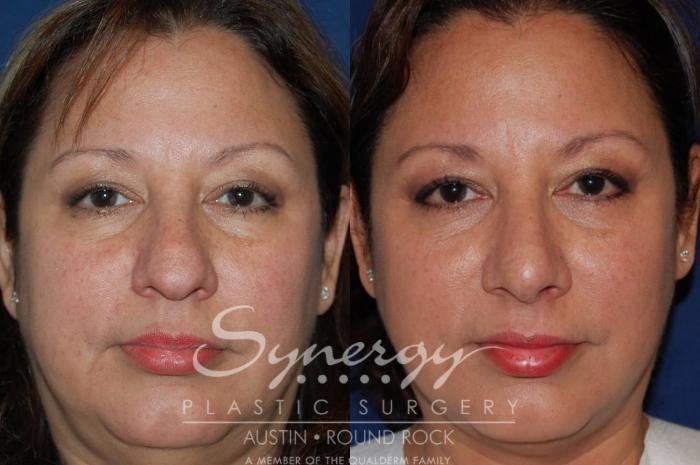 Before & After Rhinoplasty Case 89 View #5 View in Austin, TX