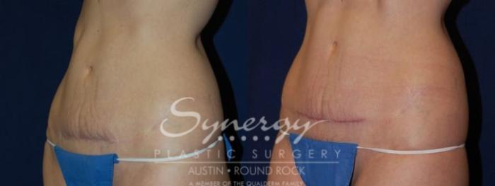Before & After Scar Revision Case 51 View #2 View in Austin, TX