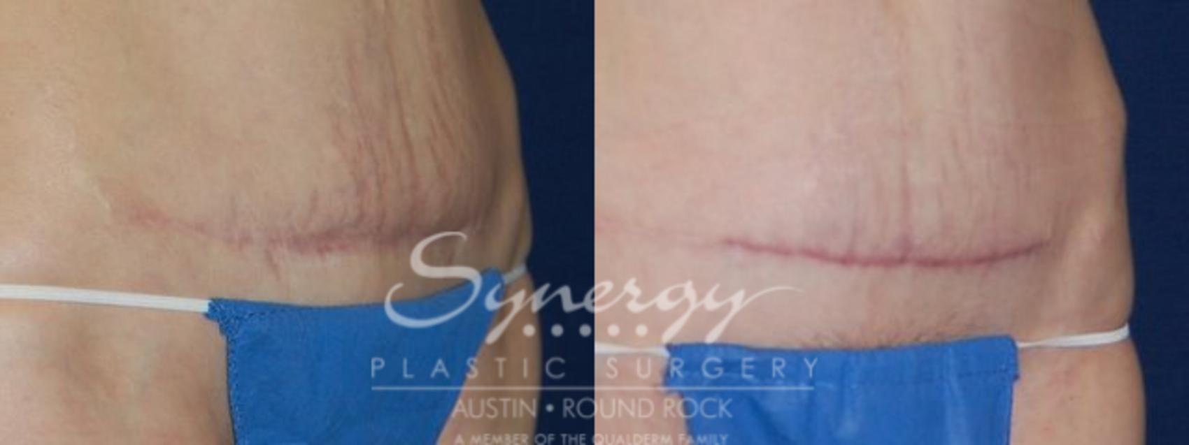 traitor Berry seed Scar Revision Before and After Pictures Case 51 | Round Rock, TX | Synergy  Plastic Surgery